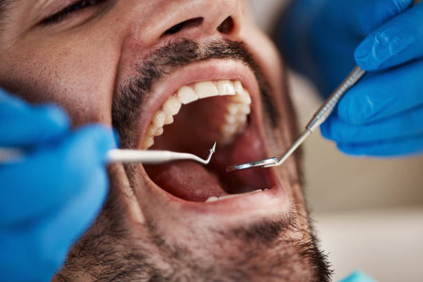 Best Emergency Dental Care for Broken or Chipped Teeth in Rodeo, CA